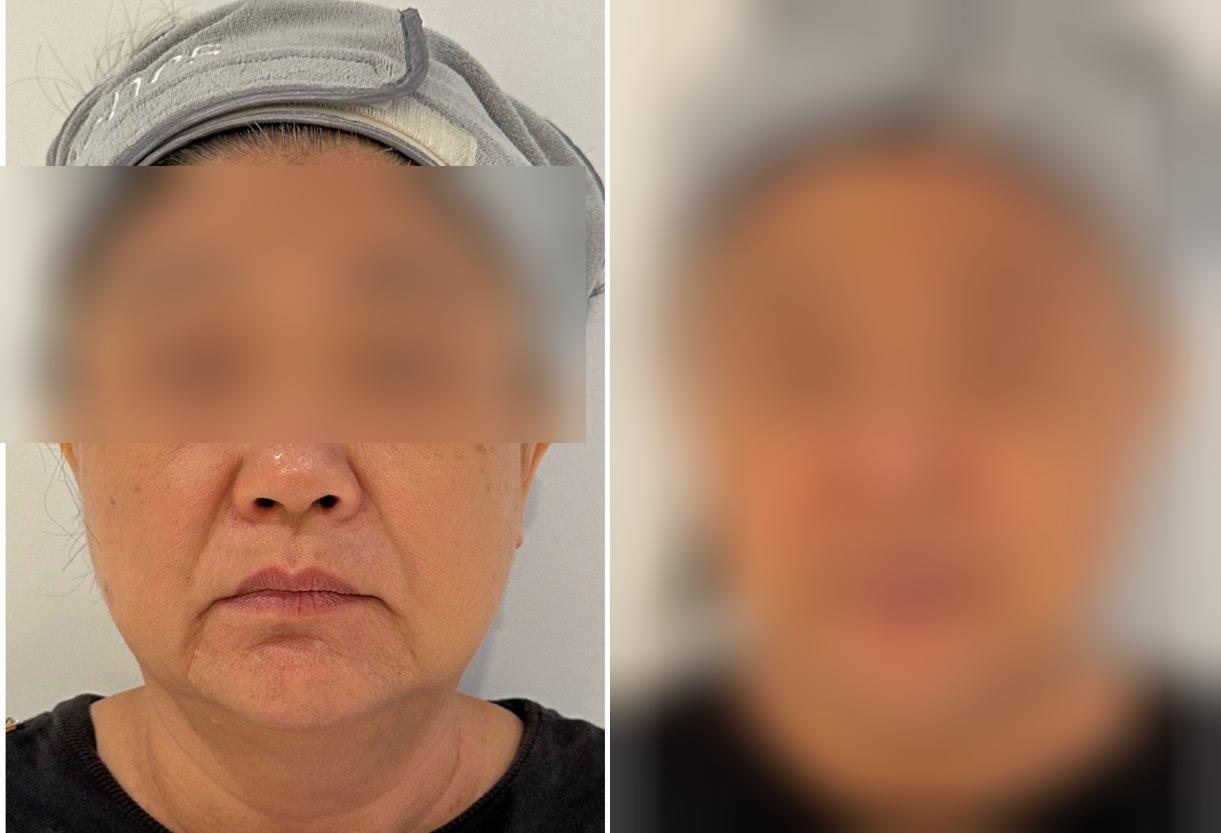 VF Facelift - Lifts Nasolabial Folds Jowls Double Chin — Atelier Aesthetics, CityLink Mall Singapore
