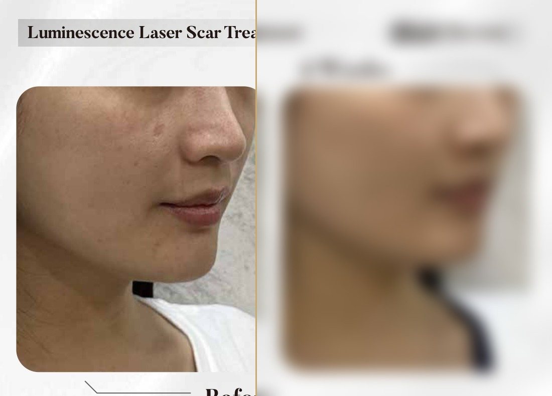 Luminescence Laser — Scar Treatment, 4 Weeks (Single Session) — Atelier Aesthetics, CityLink Mall Singapore