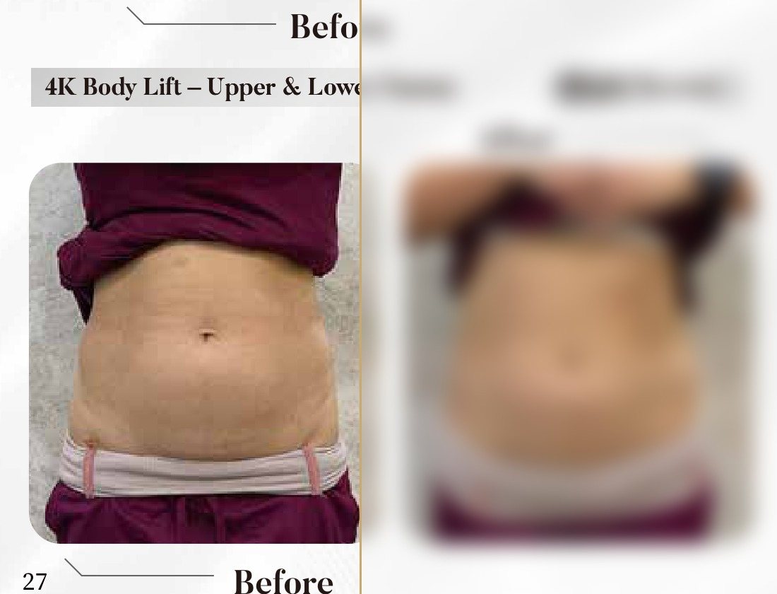 4K Body Lift — Upper & Lower Tummy (Single Session) — Atelier Aesthetics, CityLink Mall Singapore