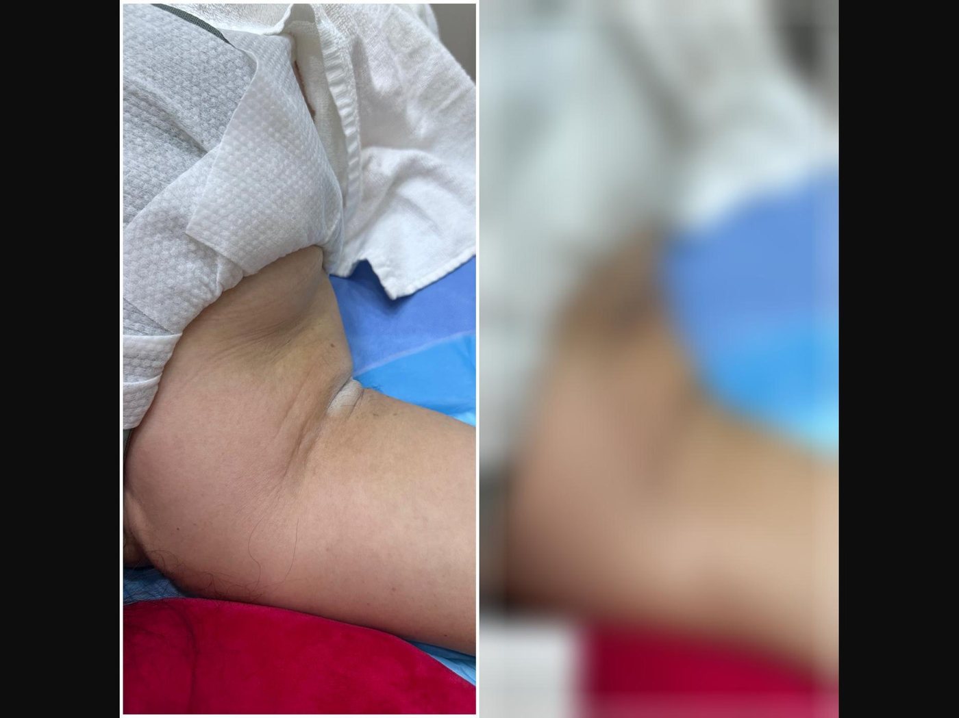 VF Body - Shapes & Tightens Underarms — Atelier Aesthetics, CityLink Mall Singapore
