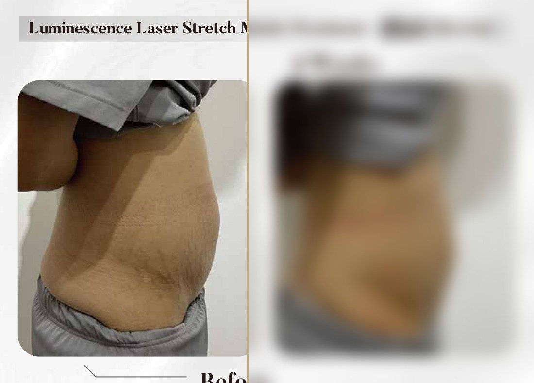 Luminescence Laser — Stretch Marks Treatment, 4 Weeks (Single Session) — Atelier Aesthetics, CityLink Mall Singapore