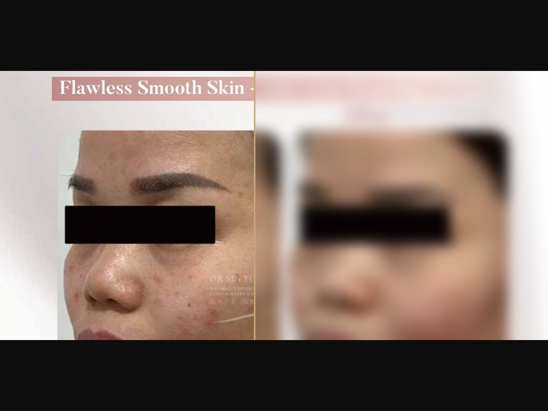 FSX Laser — Anti Acne Scarring — Atelier Aesthetics, CityLink Mall Singapore
