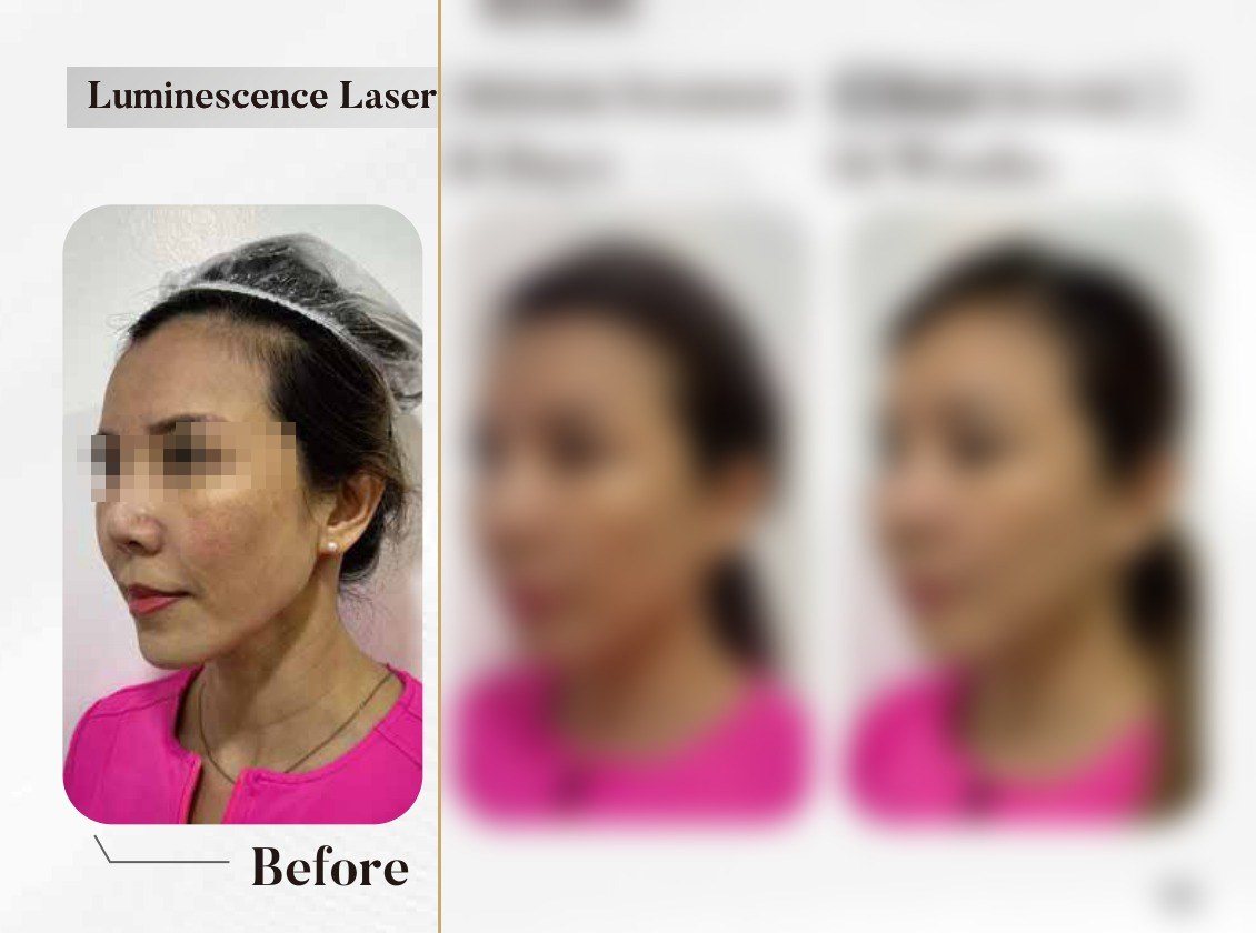 Luminescence Laser — Melasma Treatment, 6 Days & 14 Weeks (Single Session) — Atelier Aesthetics, CityLink Mall Singapore