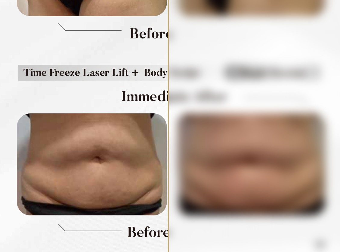 Time Freeze Laser Lift + Body Sculpt — Immediately After (Single Session) — Atelier Aesthetics, CityLink Mall Singapore