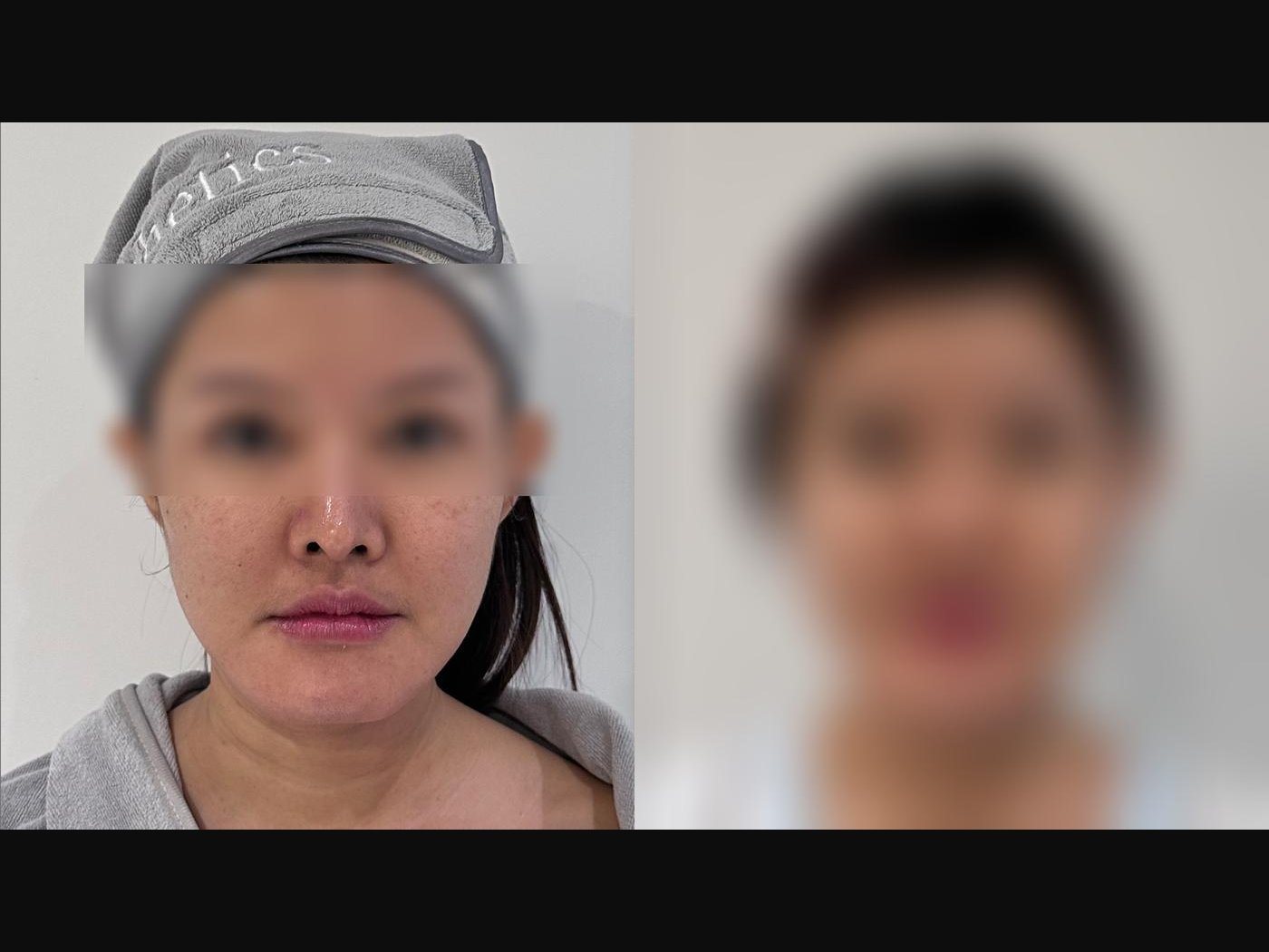 VF Facelift - Sharpens & Lifts Lower Face 7 — Atelier Aesthetics, CityLink Mall Singapore