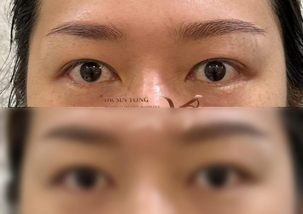 FSX Flawless Smooth Laser — Non Surgical Eye Lift for Droopy Eyelids — Atelier Aesthetics, CityLink Mall Singapore