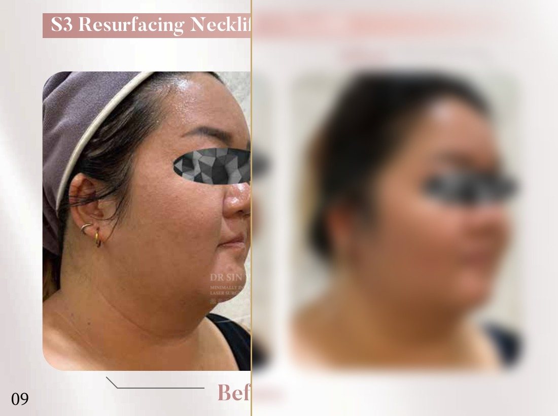 S3 Resurfacing Lift Laser — Necklift + Facelift — Atelier Aesthetics, CityLink Mall Singapore