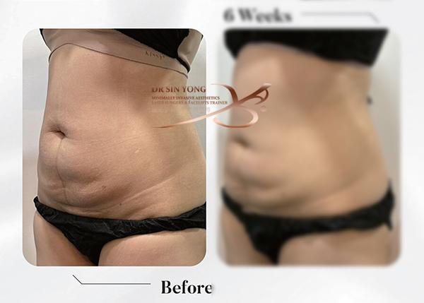 Time Freeze Laser Lift LCLR — Tummy Slimming — Atelier Aesthetics, CityLink Mall Singapore
