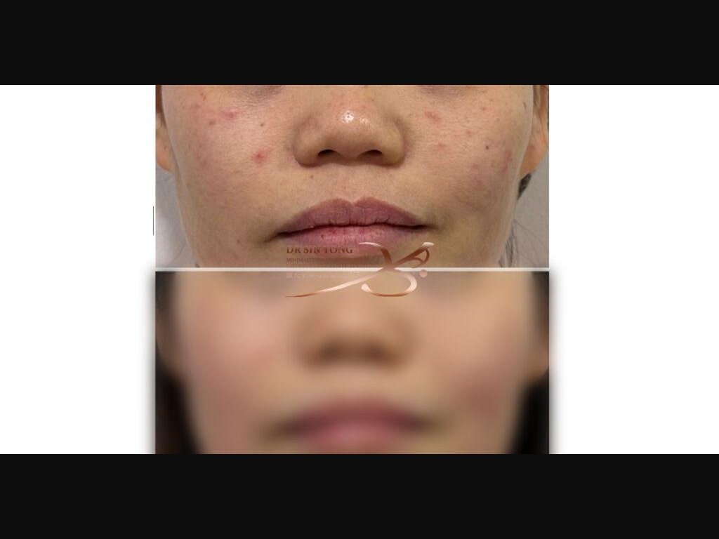 FSX Flawless Smooth Laser — 48hrs Later — Acne Treatment — Atelier Aesthetics, CityLink Mall Singapore