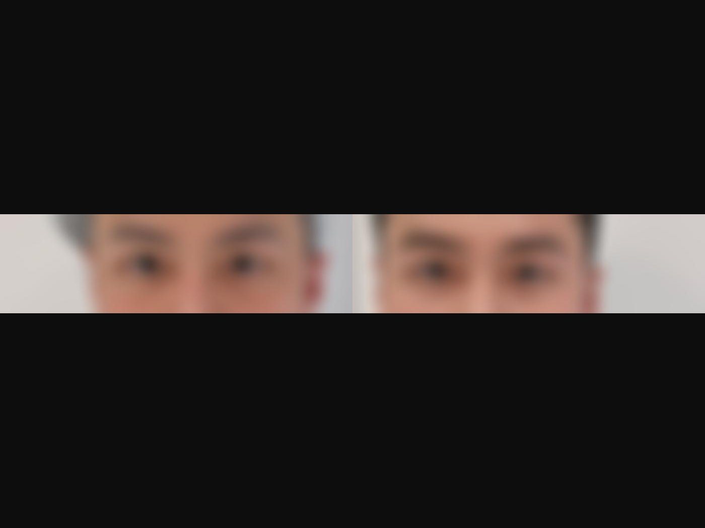 VF Periorbital Eyelift - Targets Hollowed Undereyes — Atelier Aesthetics, CityLink Mall Singapore