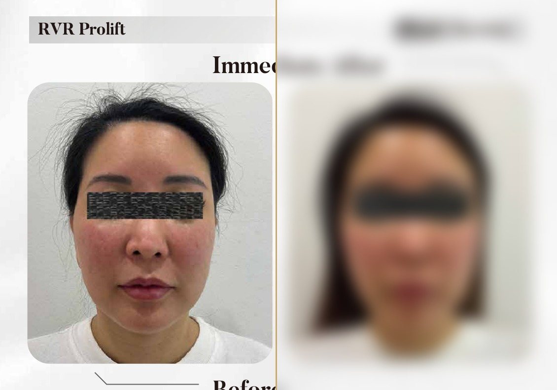 RVR ProLift — Immediately After (Single Session) — Atelier Aesthetics, CityLink Mall Singapore