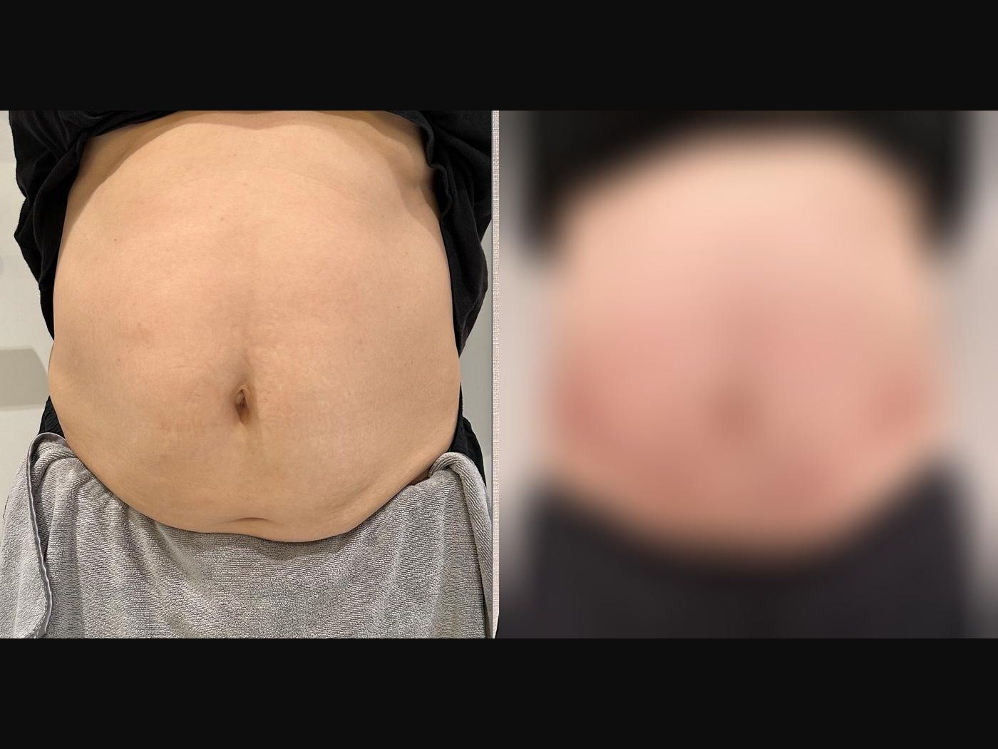 VF Body - Sculpts & Tightens Tummy — Atelier Aesthetics, CityLink Mall Singapore