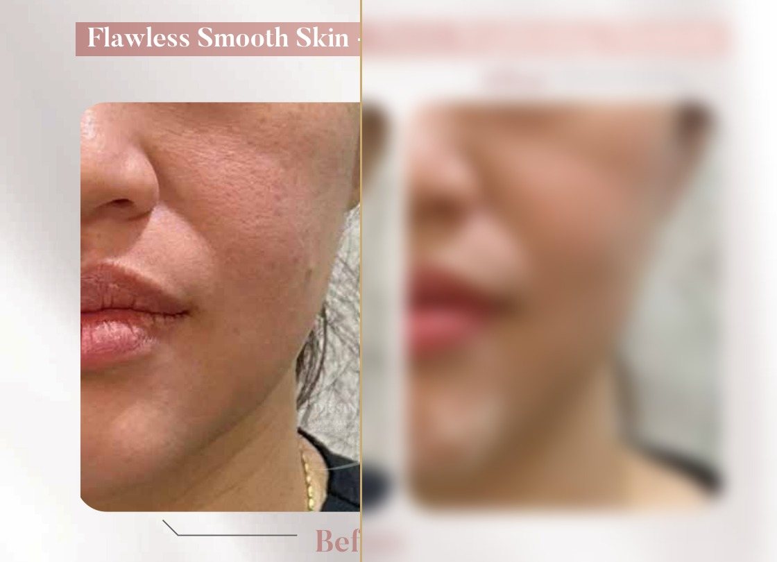 FSX Laser — Pores, Brightening & Elasticity — Atelier Aesthetics, CityLink Mall Singapore