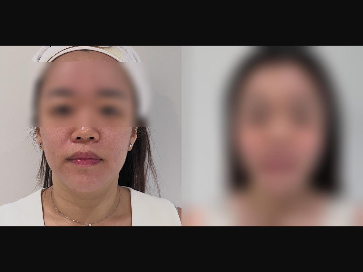 VF Facelift - Sharpens & Lifts Lower Face 6 — Atelier Aesthetics, CityLink Mall Singapore